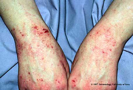 Atopic Dermatitis2.jpg