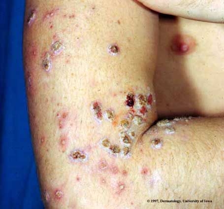 Atopic Dermatitis4.jpg