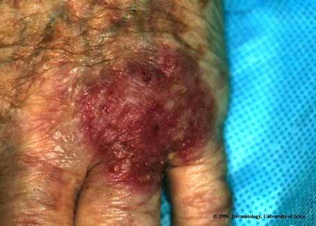 Bowen's Disease.jpg