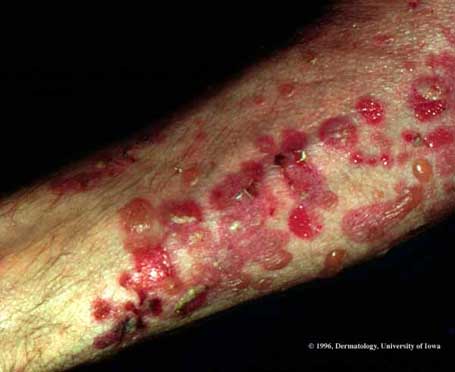 Bullous Pemphigoid.jpg