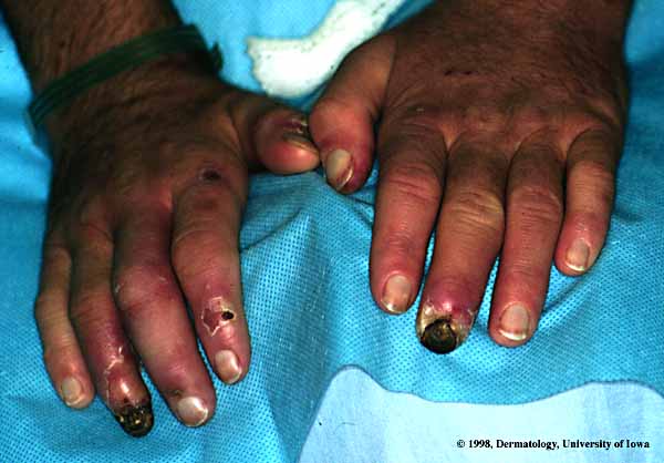 Calciphylaxis.jpg