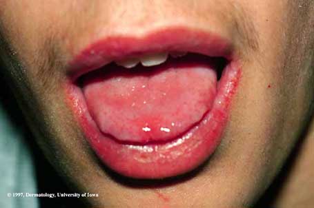 Candidiasis1.jpg