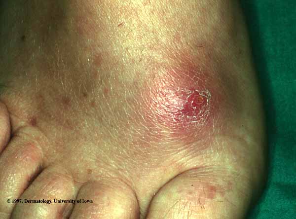 Cellulitis.jpg