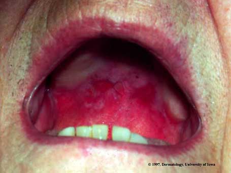 Cicatricial Bullous Pemphigoid.jpg