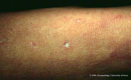 Degos Disease.jpg