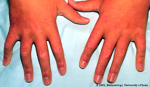 Dermatomyositis-05 (1).jpg