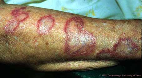 Discoid Lupus Erythematosus1.jpg