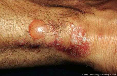 Epidermal Bullosa Acquisita.jpg