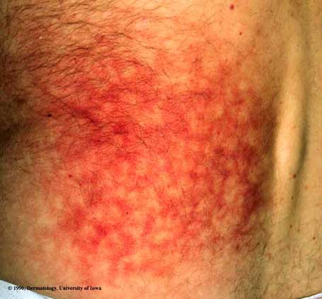 Erythema Ab Igne.jpg