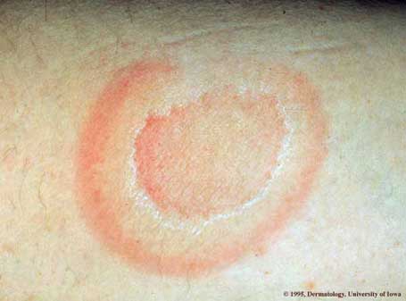 Erythema Annulare Centrifugum.jpg