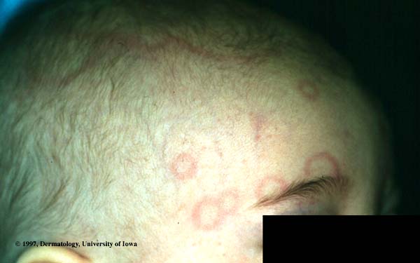 Erythema Annulare of Infancy.jpg