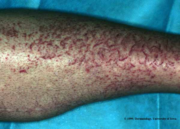 Erythema Craquele.jpg