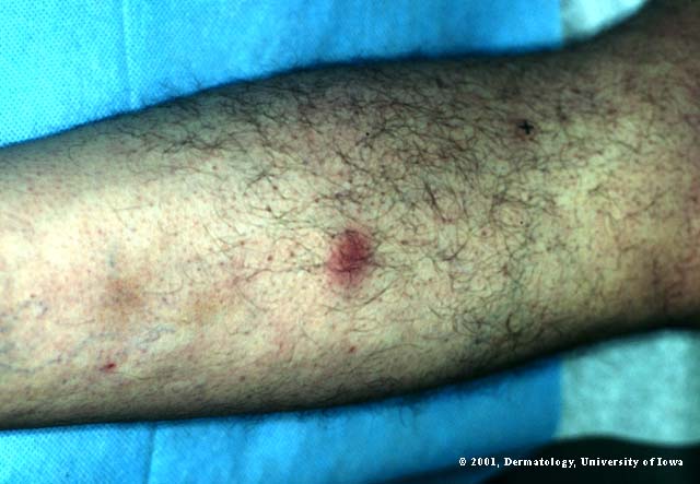 Erythema Induratum.jpg