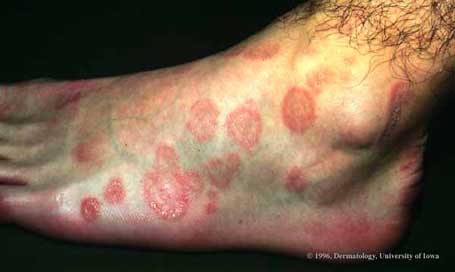 Erythema Multiforme.jpg