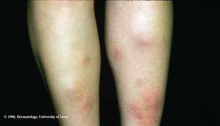 Erythema Nodosum.jpg