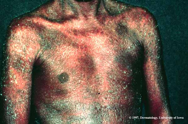 Exfoliative Erythroderma.jpg