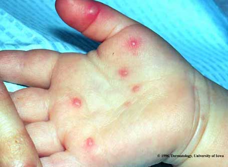 Hand, Foot and Mouth Disease.jpg