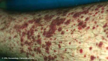 Henoch-Schonlein Purpura Vasculitis.jpg