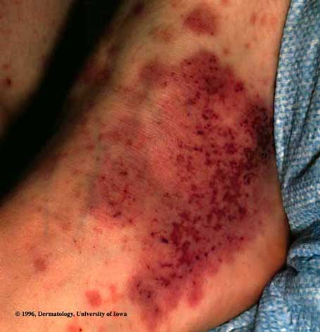 Henoch-Schonlein Purpura Vasculitis2.jpg