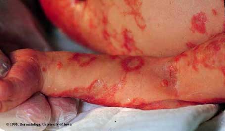 Herpes Simplex- Congenital.jpg