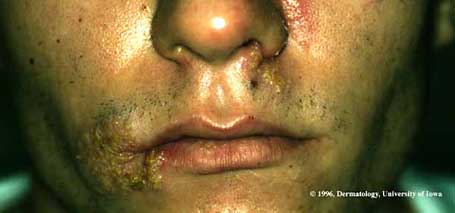 Herpes Simplex.jpg