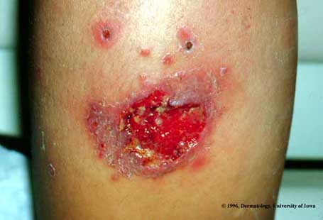 Leishmaniasis.jpg