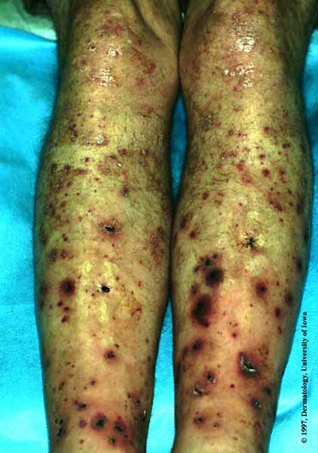 Leukocytoclastic Vasculitis.jpg