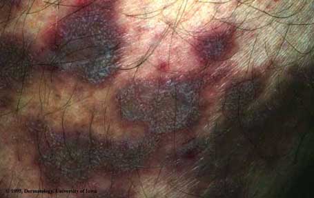 Lichen Planus.jpg