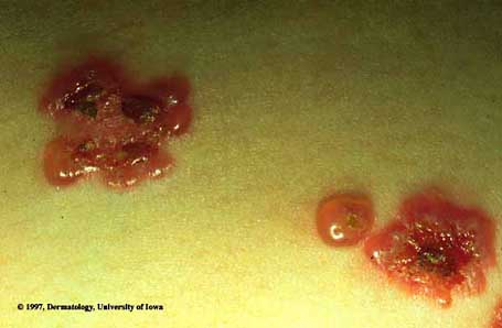 Linear IgA Bullous Dermatosis.jpg