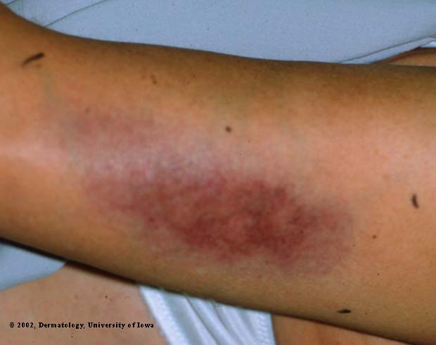 Lupus Erythematosus- Profundus1.jpg