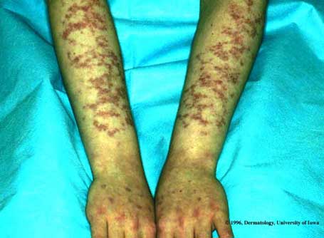 Lupus Erythematosus1.jpg