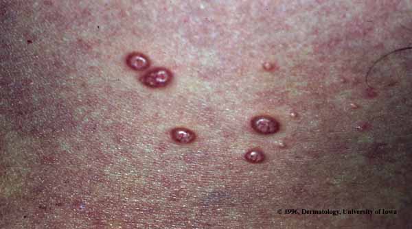 Malignant Atrophic Papulosis.jpg