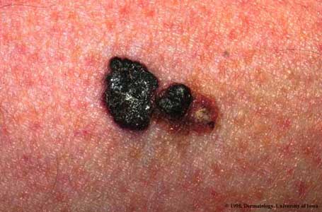 Malignant Melanoma2.jpg