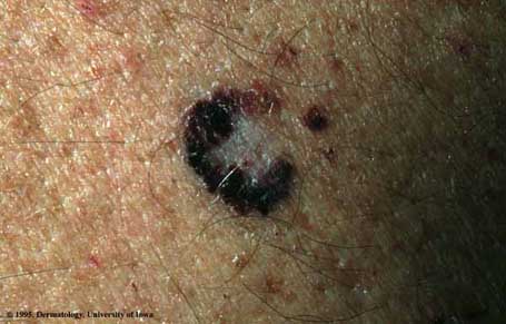 Malignant Melanoma3.jpg