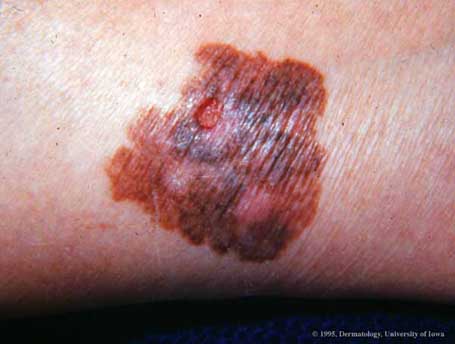 Malignant Melanoma4.jpg