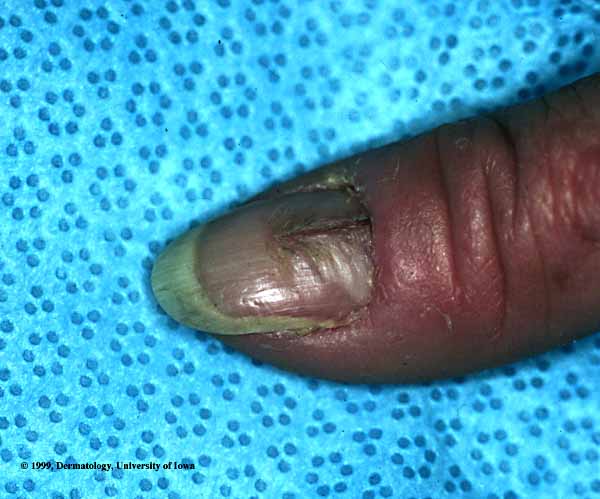 Median Nail Dystrophy.jpg