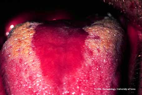 Median Rhomboid Glossitis.jpg