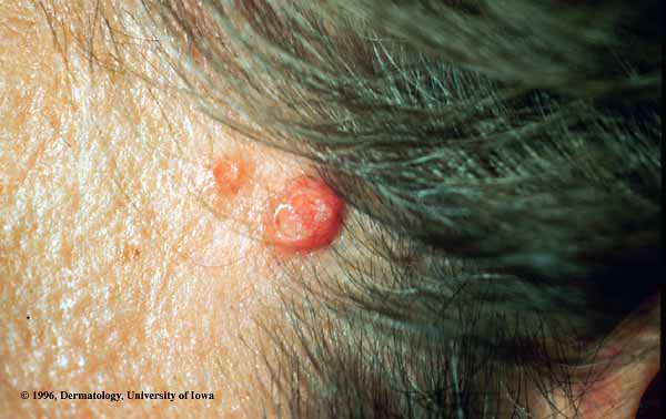 Molluscum Contagiosum.jpg