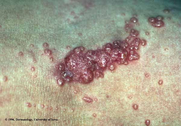 Molluscum Contagiosum3.jpg