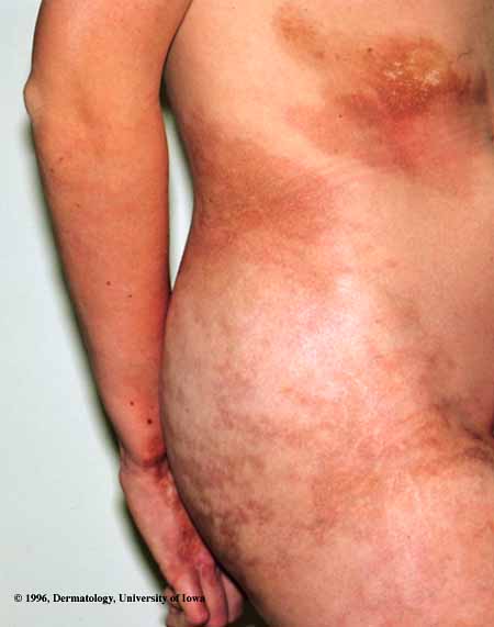 Morphea1.jpg