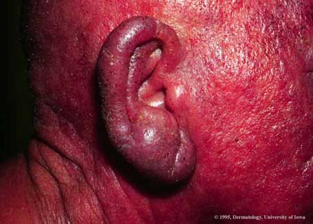 Mycosis Fundoides1.jpg