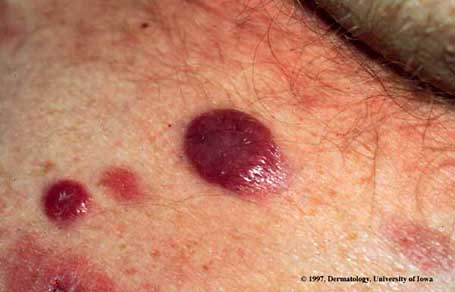 Mycosis Fundoides2.jpg