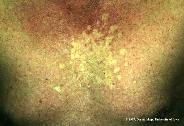 Nevus Anemicus.jpg