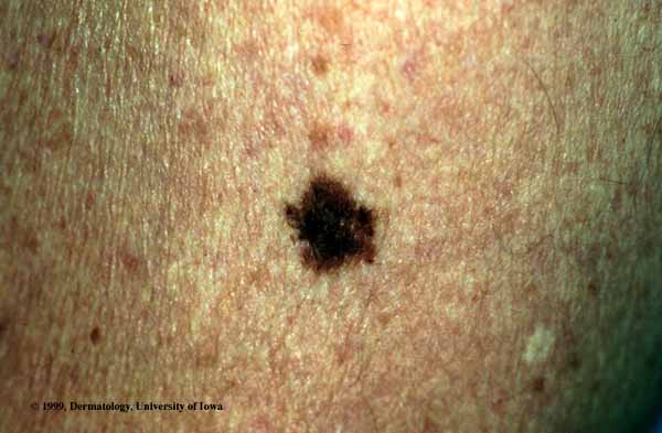 Nevus Melanocytic.jpg