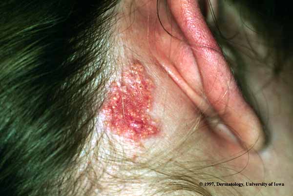 Nevus Sebaceous.jpg