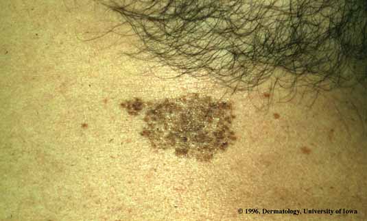 Nevus Spilus.jpg