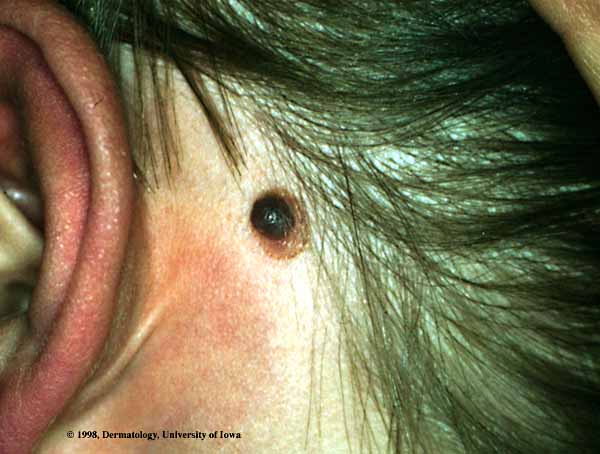 Nevus, Spitz Type 1.jpg