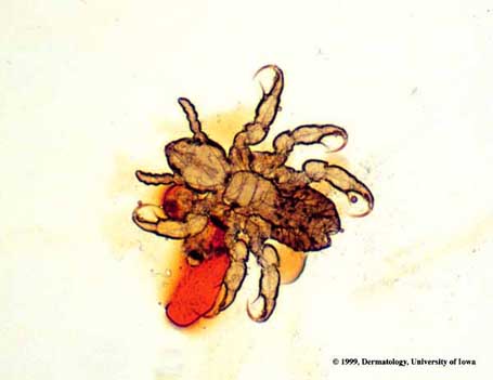 Pediculus humanus.jpg