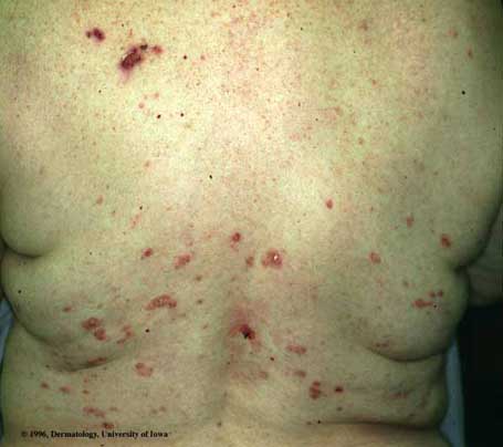 Pemphigus Foliaceus.jpg