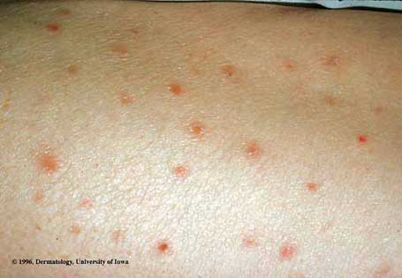 Pityriasis Lichenoides et Varioliformis Acuta1.jpg